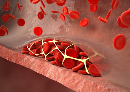 Нет тромбозу: флеболог назвал 3 важных продукта — уменьшают вязкость крови и растворяют тромбы