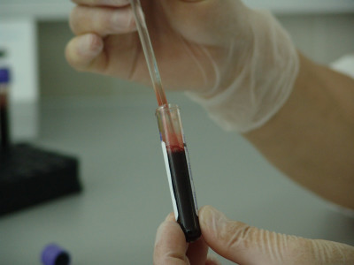Моментальное разжижение густой крови: доктор назвал продукт от тромбоза — лекарства не понадобятся