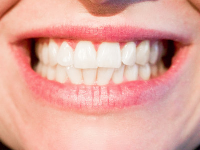 «Рекомендация по-настоящему опасная»: стоматолог Блюмкин назвал самые вредные методы отбеливания зубов
