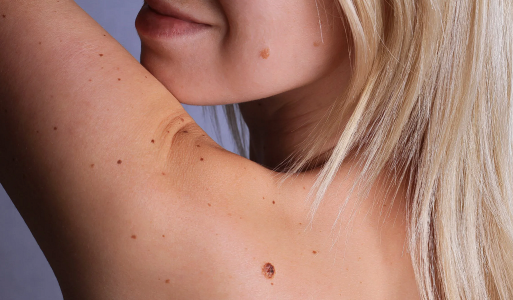 «Можно ли удалять родинки?»: Онколог назвала 7 основных способов профилактики рака кожи — распространены 3 патологии